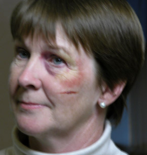 Anne with black eye and gash after make-up applied